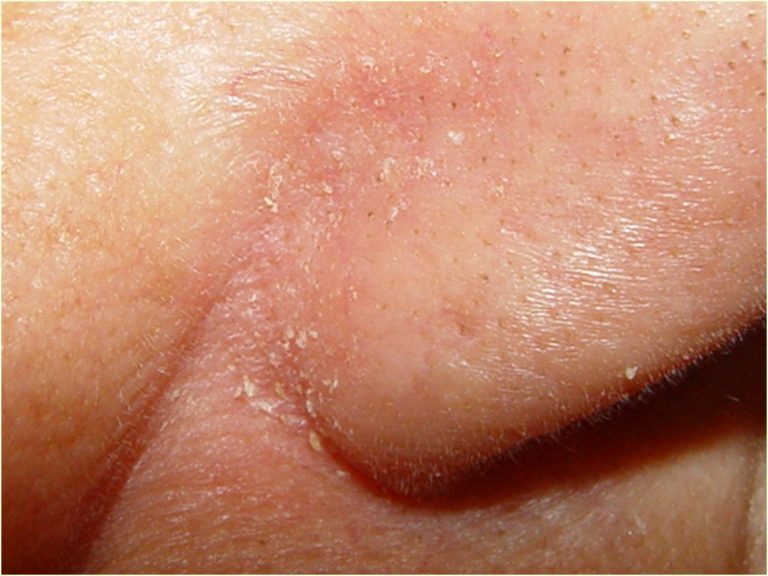 Dermatite Seborreica Conhe A Os Sintomas E A Causa Prontopele