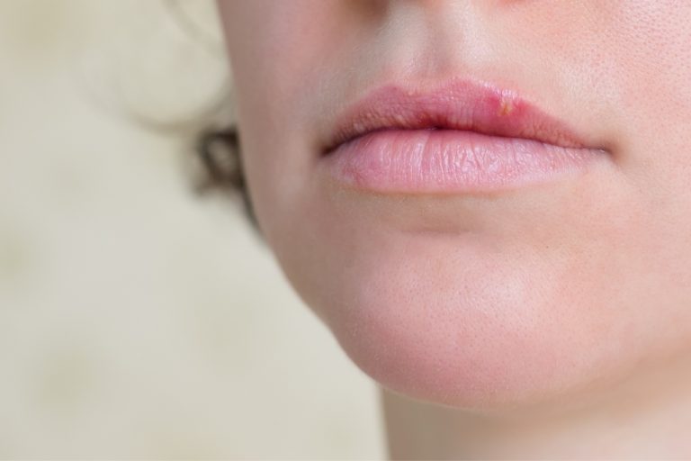 bumps-on-lips-small-little-white-or-red-causes-treatment-american