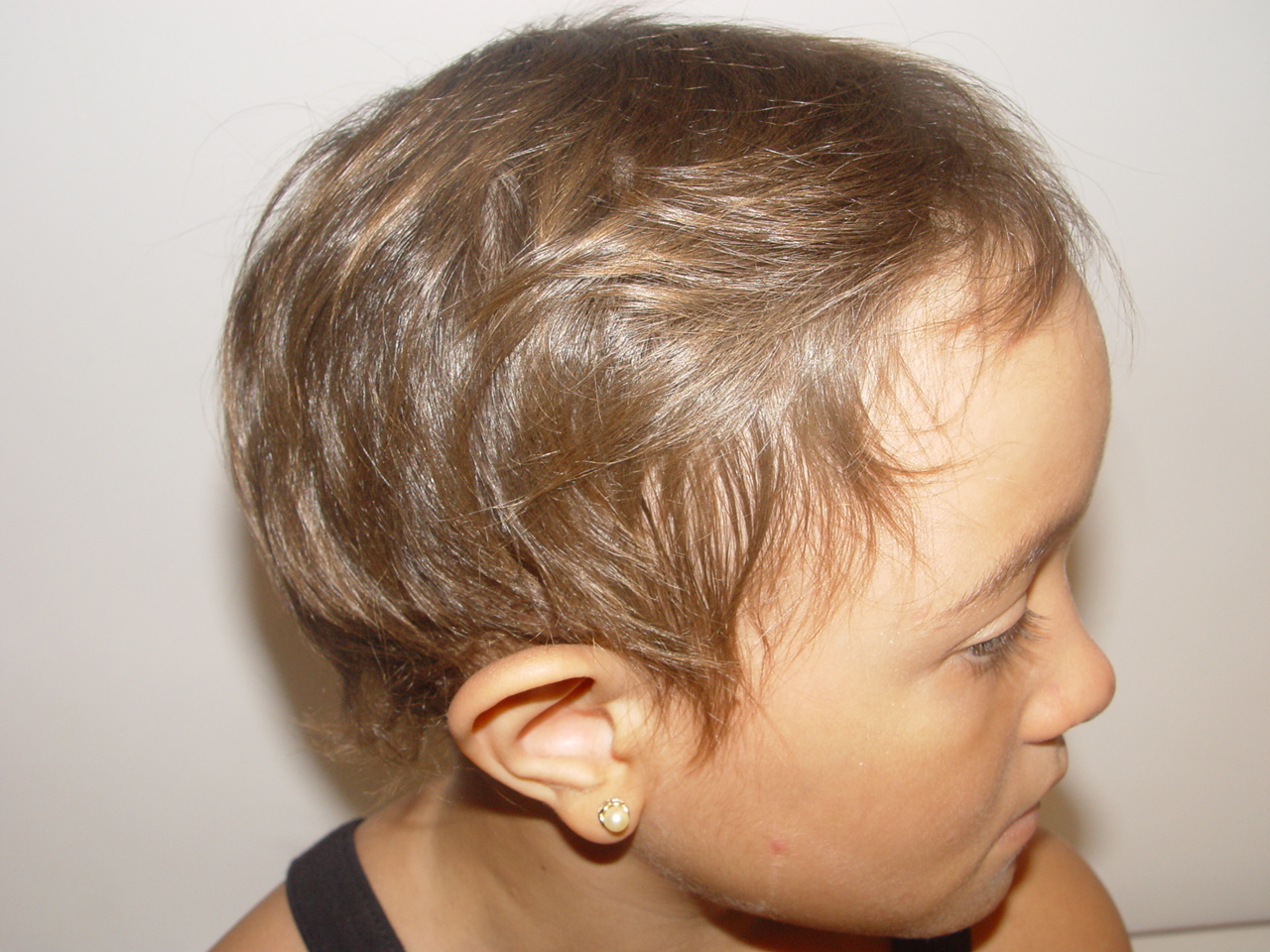 Saiba Mais Sobre A Alopecia Areata Pronto Atendimento Da Pele Prof S Rgio Paulo