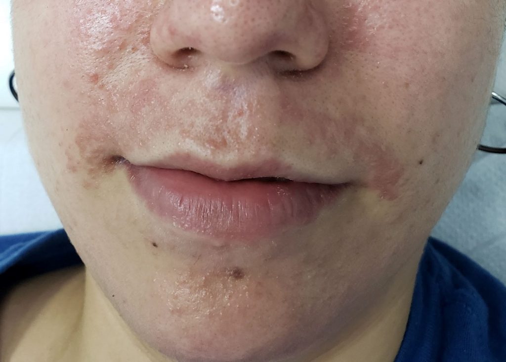 Dermatite Perioral/Periorificial, ao redor da boca e nariz