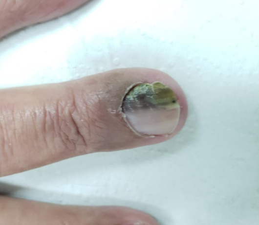 Infecção pela bactéria pseudomona na unha do dedo