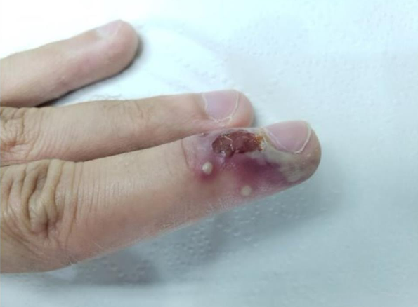 Paroníquia aguda intensa, onde se observa pústulas (coleção de pus) e inflamação ao redor da unha do dedo médio da mão