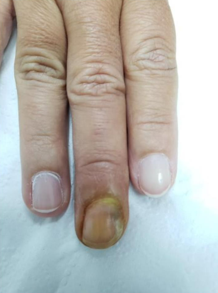 Paroniquía aguda com coleção de pus abaixo da unha do dedo médio