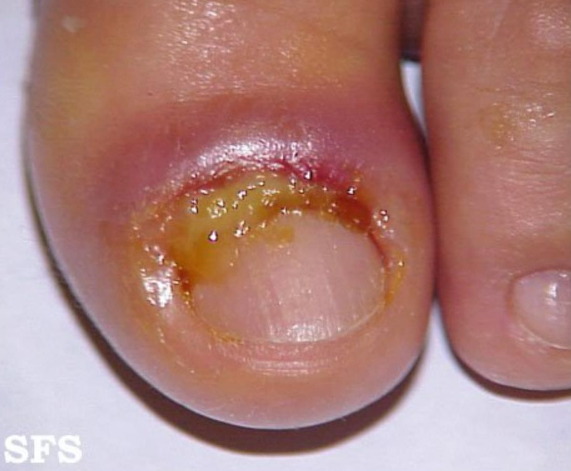 Paroníquia aguda no primeiro dedo do pé