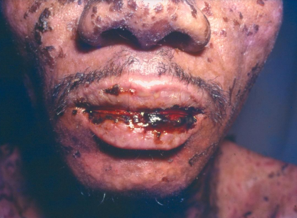 Síndrome de Stevens-Johnson, com crosta sanguinolenta no lábio inferior
