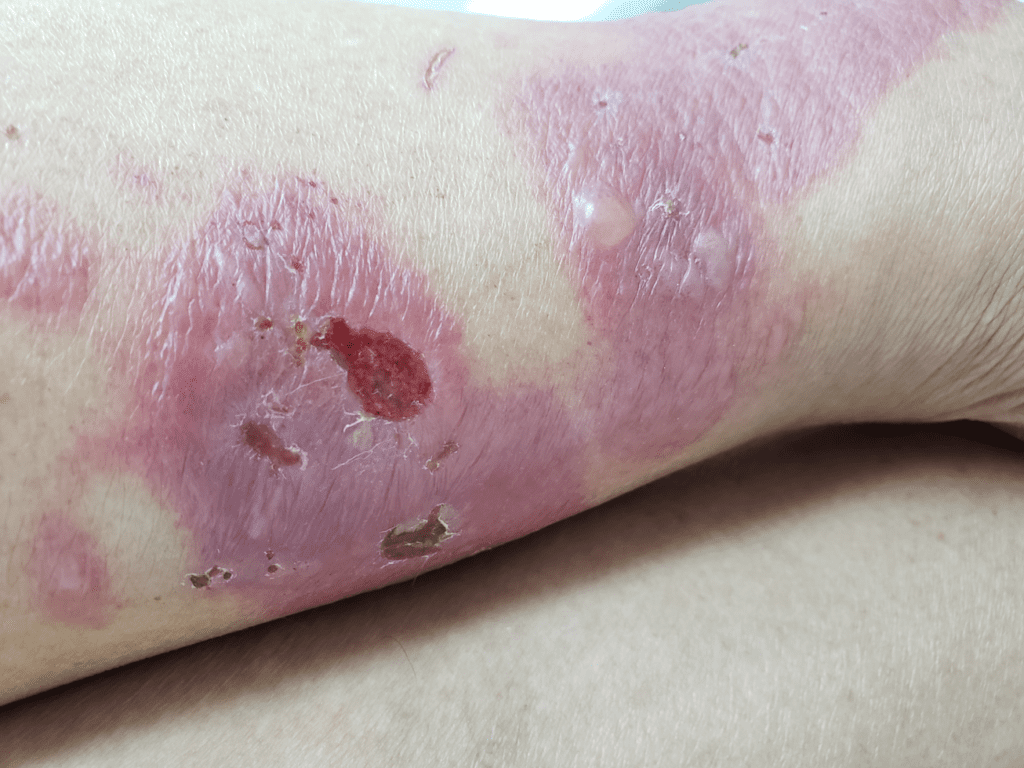 Eritema polimorfo manifestado por, além de inchaço e vermelhidão, vesículas e bolhas na perna, estas últimas consequente à maior inflamação da pele