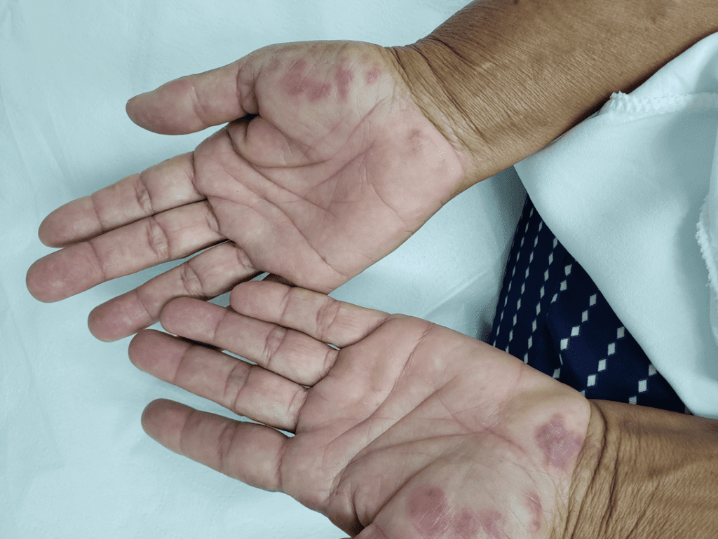 Eritema polimorfo nas palmas das mãos