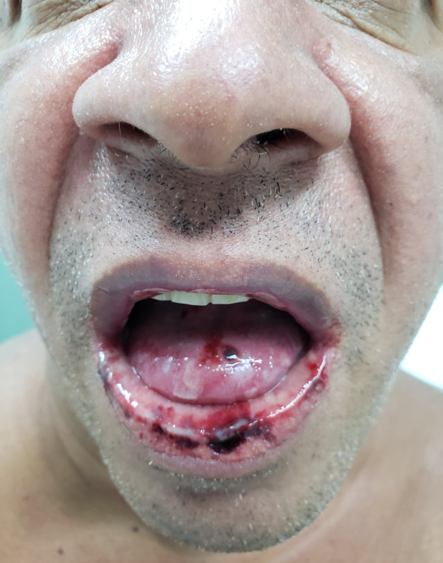 Eritema polimorfo atingindo o lábio inferior e a língua