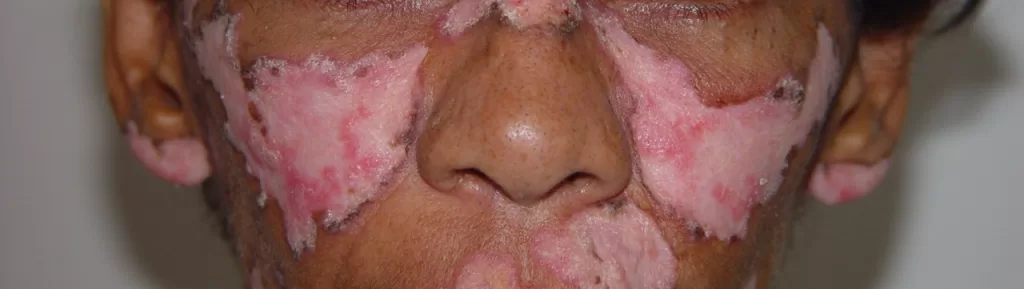 Orelhas: A atrofia cutânea, particularmente na área interna, pode levar a lesões semelhantes às do vitiligo (fotos 11 a e 12) 