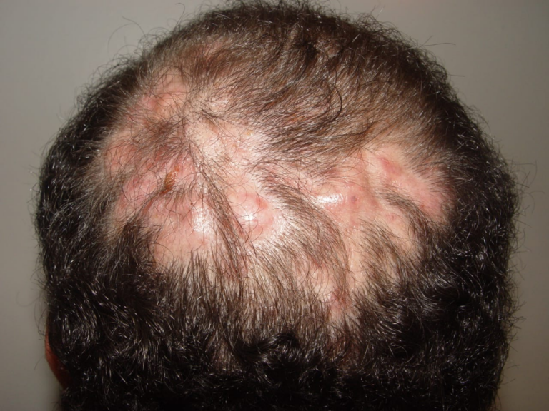 Foliculite Abscedante do Couro Cabeludo: Causas, Sintomas e Tratamentos ...